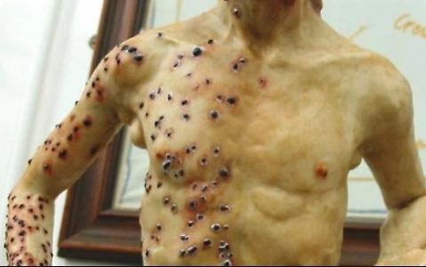 1440704318038_jpg--pustole__pus__sangue_e_morteboom_di_casi_di_peste_bubbonica